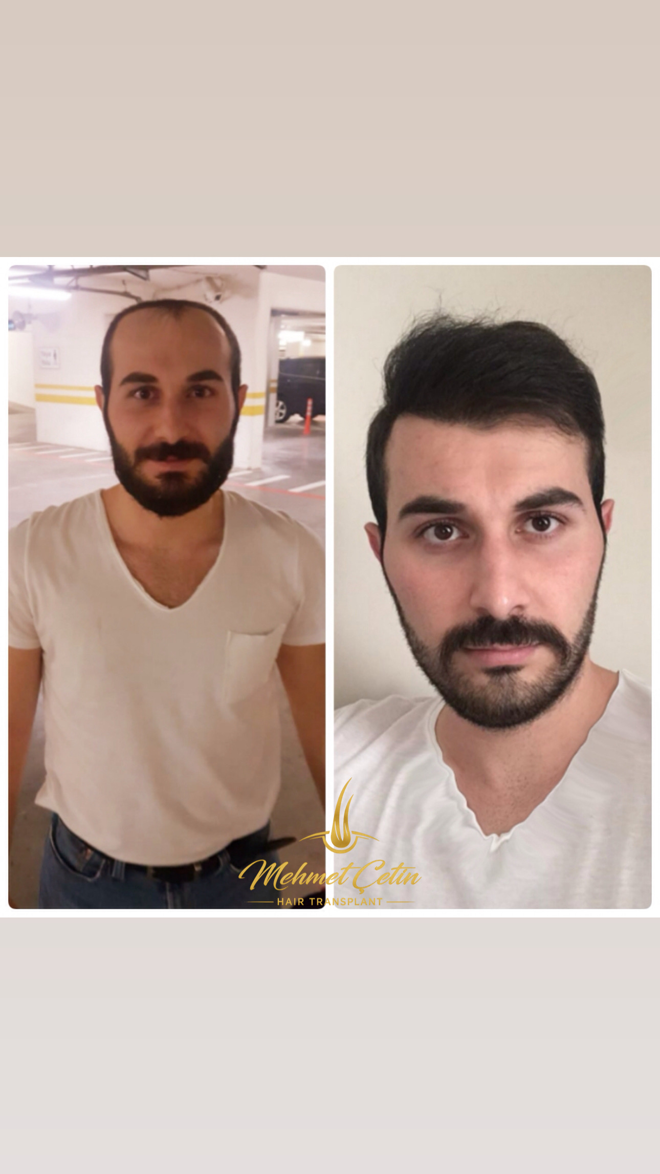 Doğal saç çizgisi öncesi ve sonrası